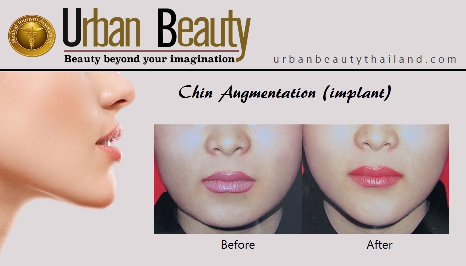 chin-augmentation_thailand