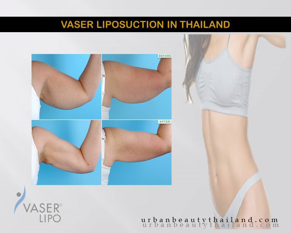 arm-liposuction-vaser-thailand