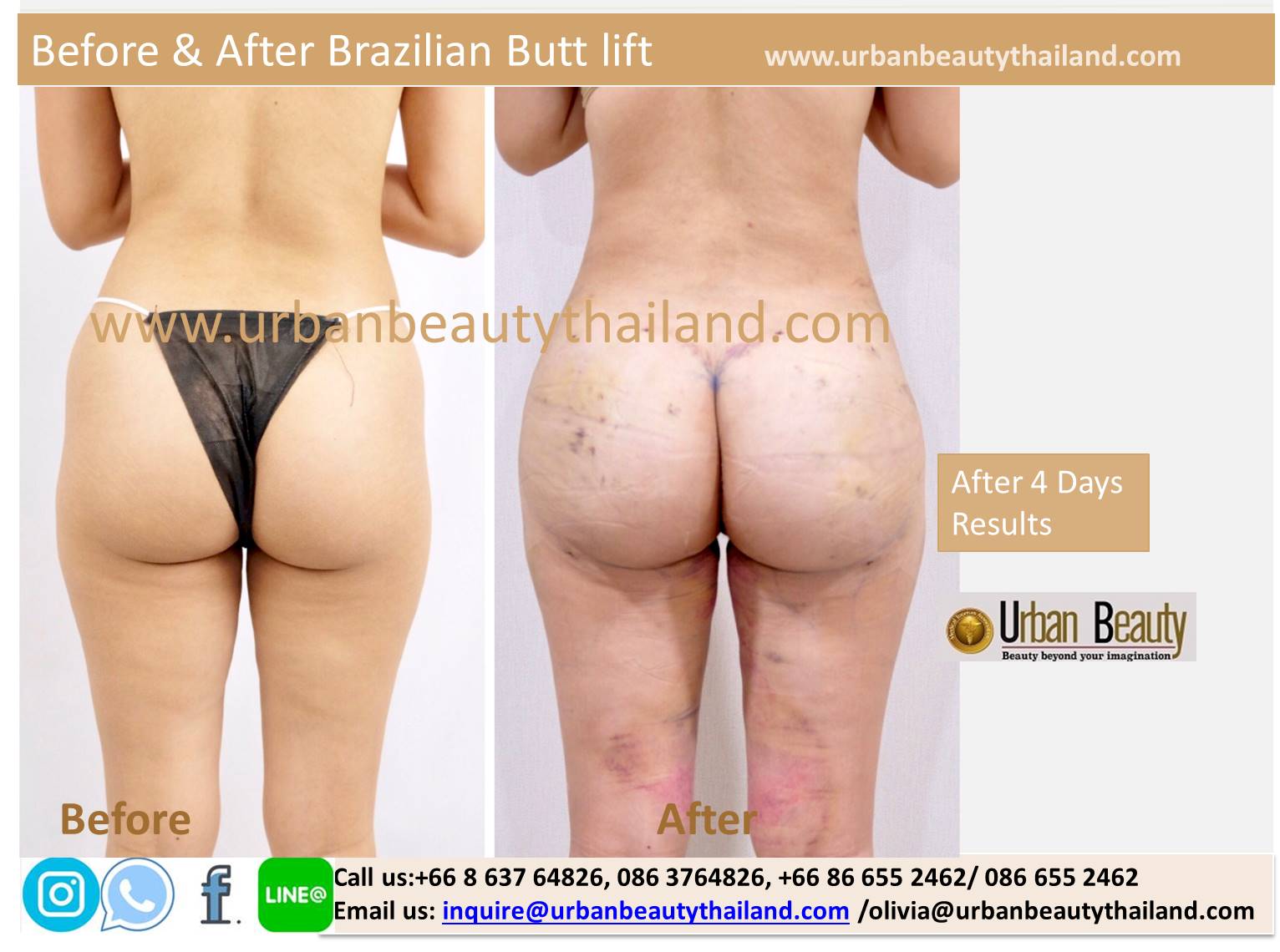 Butt Lift in Thailand  Interplast Clinic Bangkok, Thailand