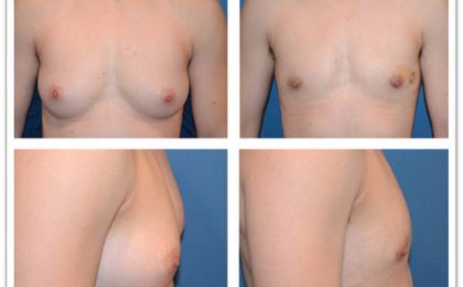 Breast gland removal (FtM)