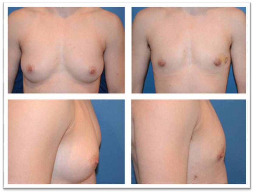 breast gland removal ftm Thailand