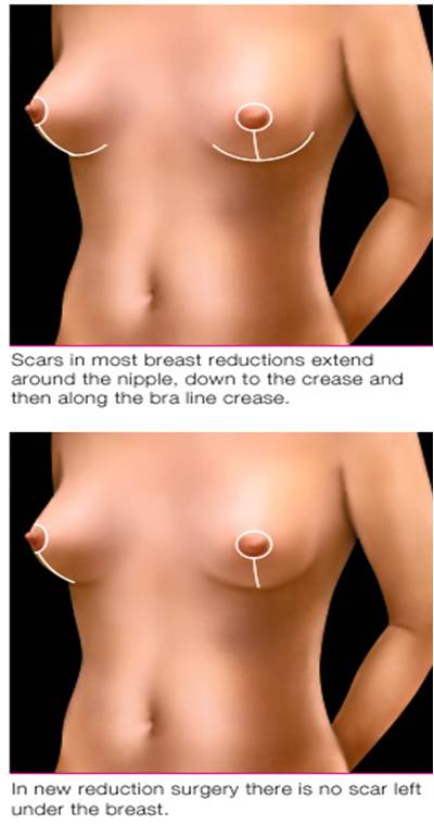 breast reduction thailand bangkok