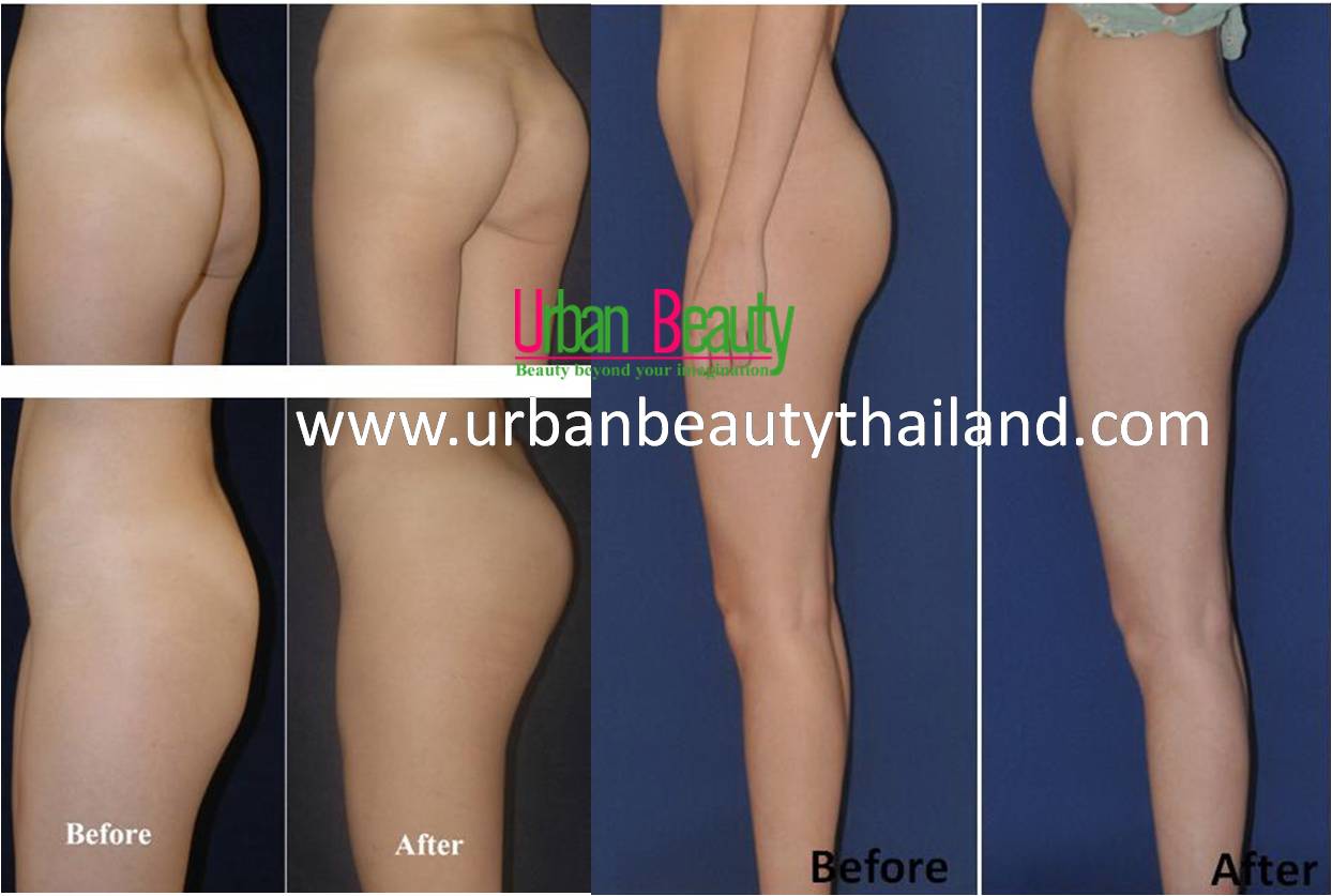 buttock augmentation butt implant thailand bangkok