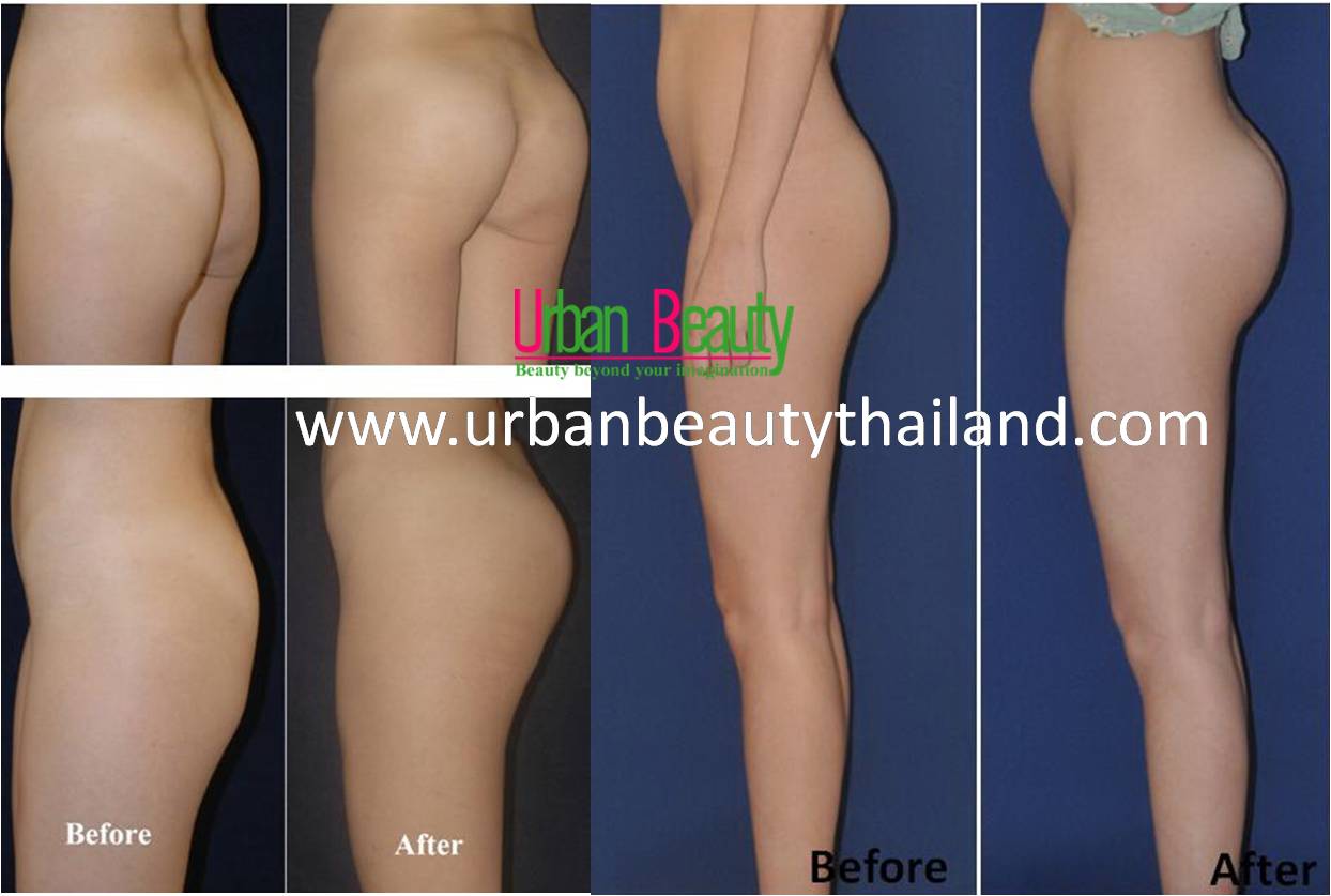 Butt Augmentation in Thailand  Interplast Clinic Bangkok, Thailand