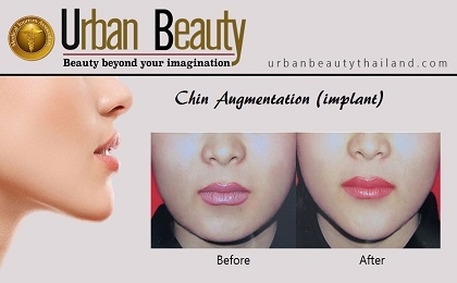 Chin Augmentation Thailand