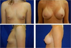 endoscopic breast augmentation Thailand bangkok Phuket