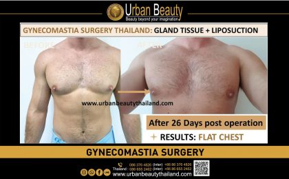 Male Breast Reduction & VASER Hi Def Six-Pack Contouring in Thailand