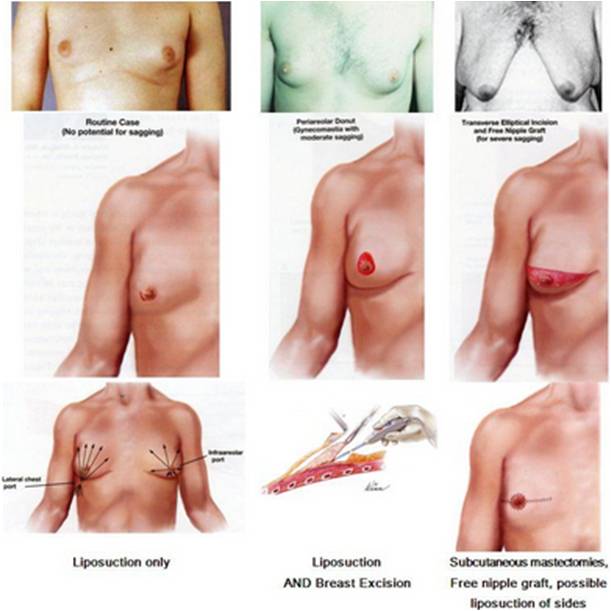 gynecomastia, male breast reduction Thailand