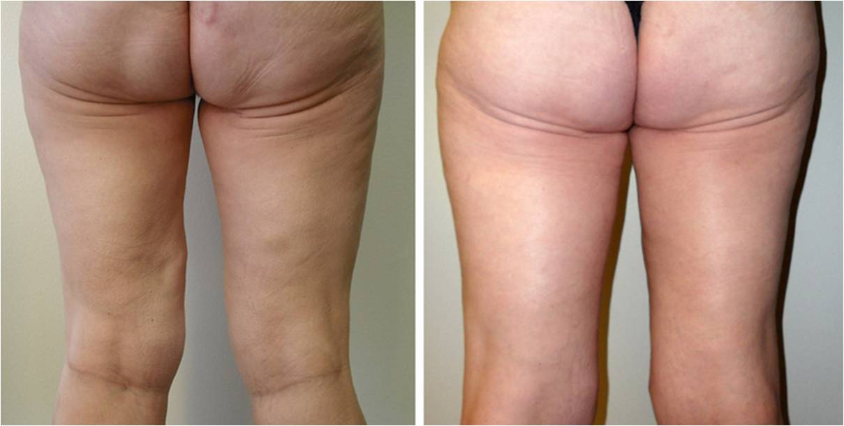 thigh lift before after thailand