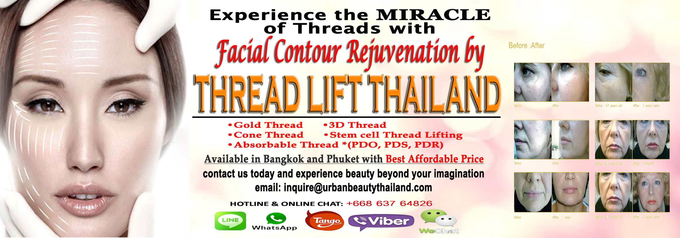 thread lift thailand mini face lift