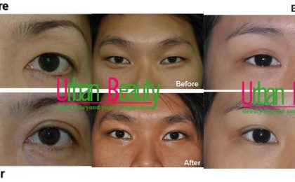 Asian Blepharoplasty Eyelid Surgery Thailand