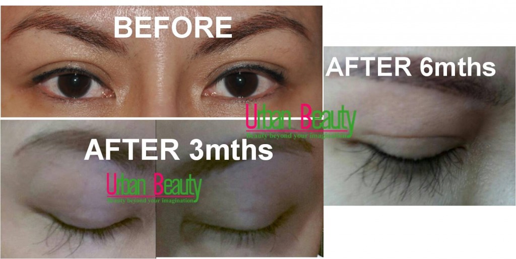 winnie eyelash transplant before and after