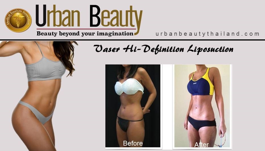 Liposuction & Hi def fat removal bangkok thailand