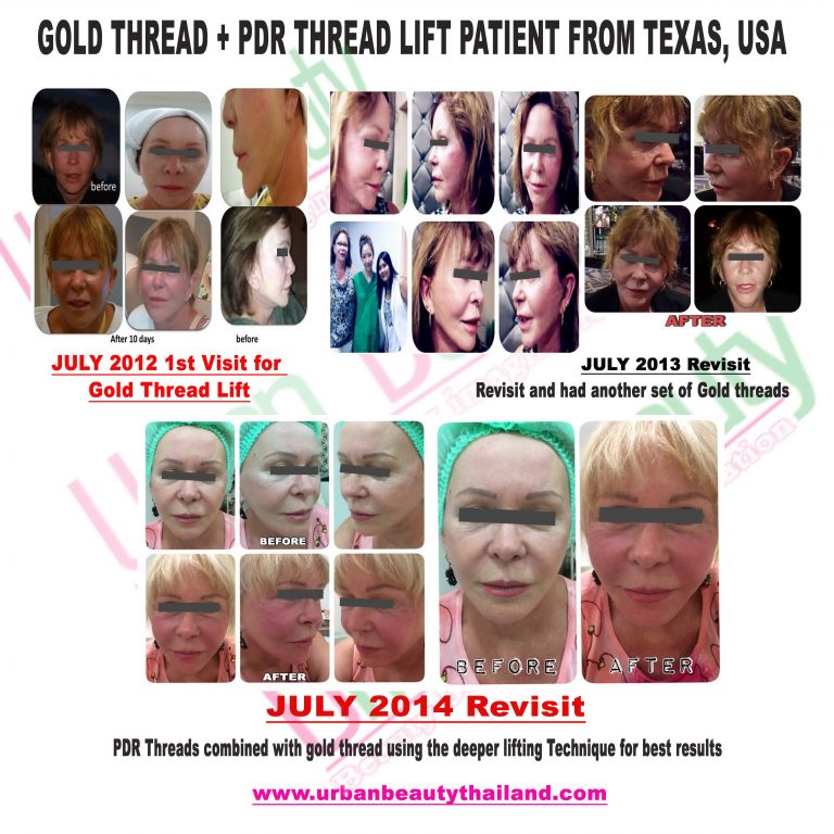 Gold Thread Lift Face Lift Thailand