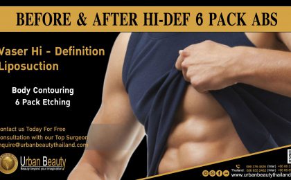 Male Liposuction Thailand/Fat Removal Thailand