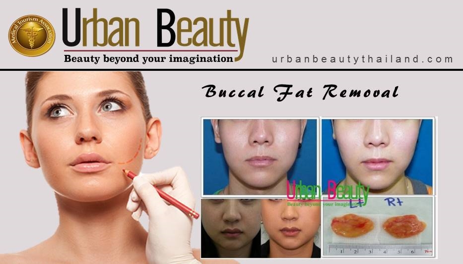 BUCCAL FAT REMOVAL_bangkok phuket thailand