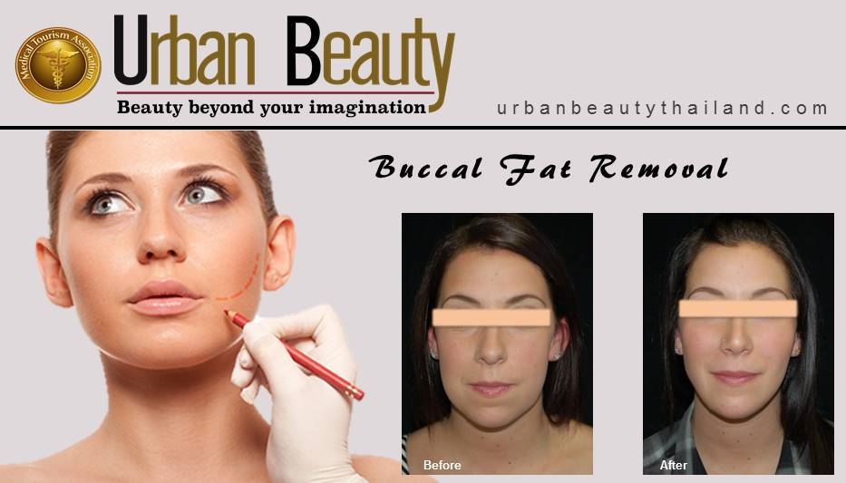 BUCCAL FAT REMOVAL_bangkok thailand bangkok