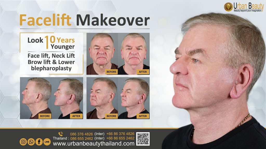 MACSLift Facelift Thailand Urban Beauty Thailand