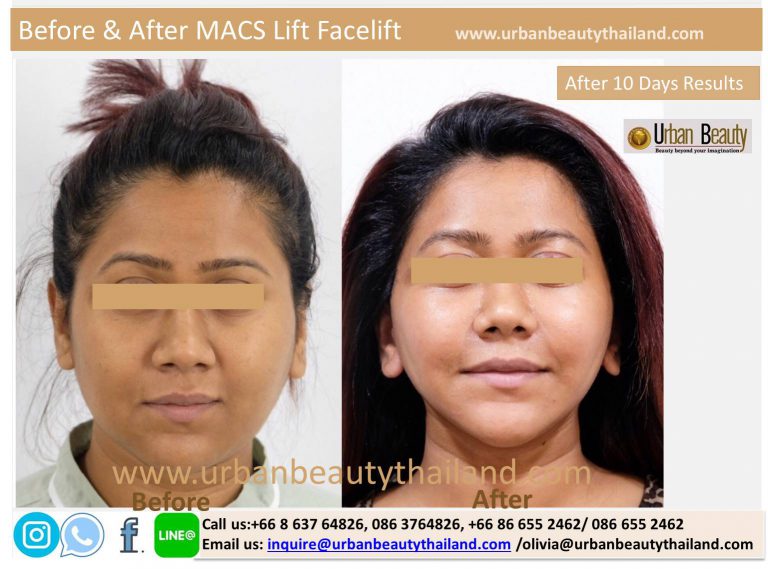 MACSLift Facelift Thailand Urban Beauty Thailand