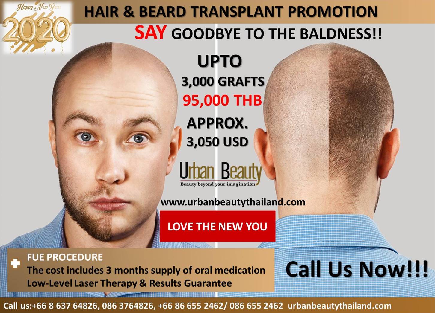 FUE Hair Transplant What to Expect Cost Pictures and More