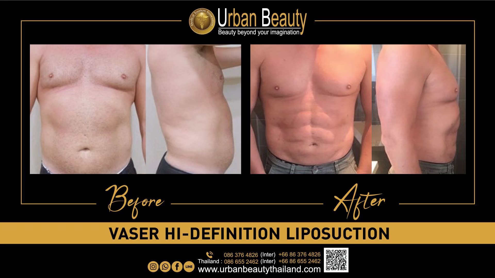 Abdominal Sculpting (6-pack) Before and After - Bluewater Plastic Surgery