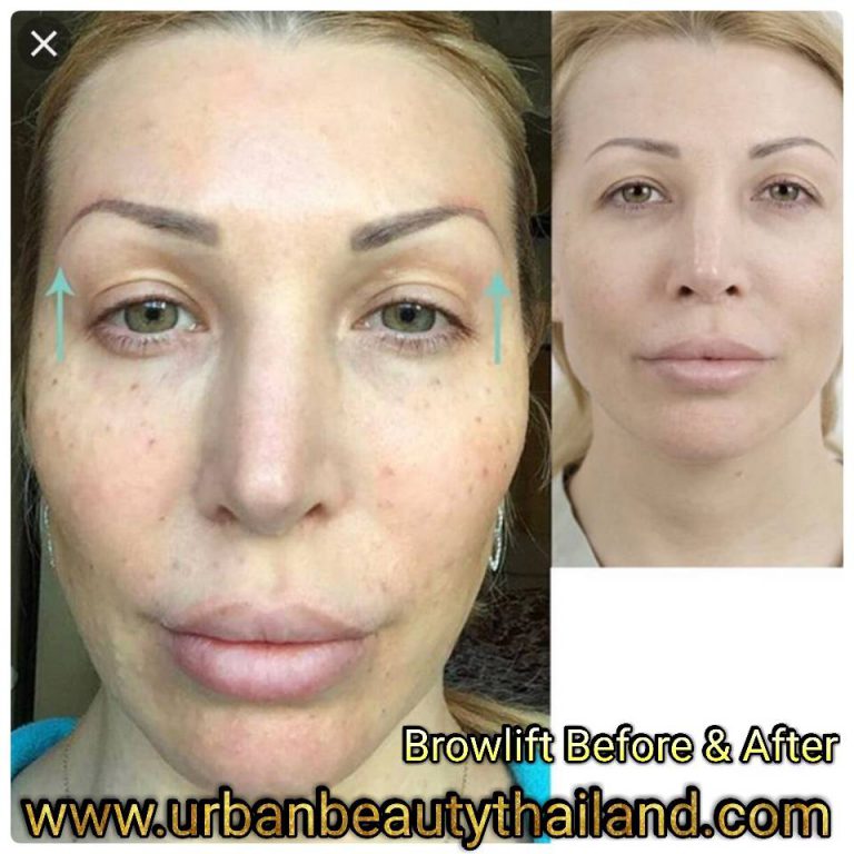 Mini Facelift, Quicklift, Weekend Facelift Thailand Cost Urban Beauty