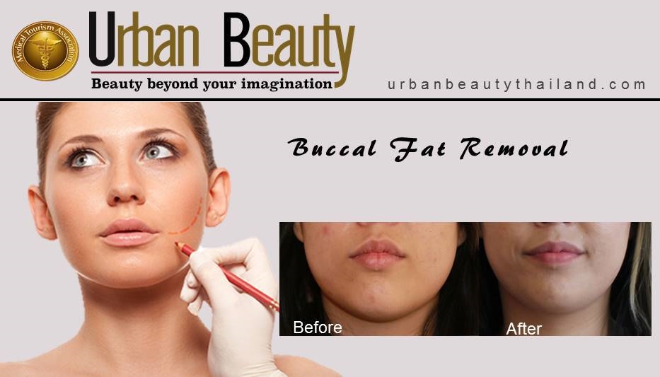 buccal fat removal thailand