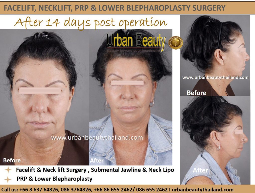 Facelift in Thailand Rhytidectomy Urban Beauty Thailand
