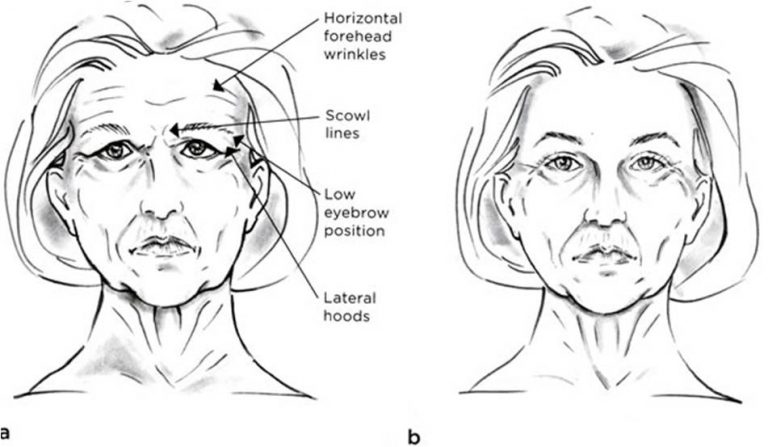 Facelift Temple Lift Thailand, Brow lift, Mid facelift Thailand