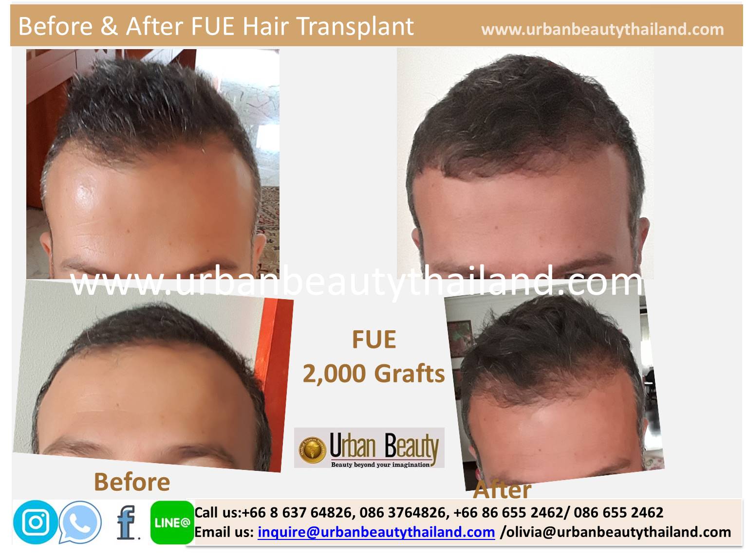 Hair Transplant Microsurgery Thailand - Urban Beauty Thailand