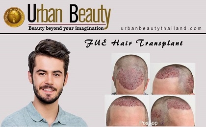 fue-hair-transplant-bangkok-thailand