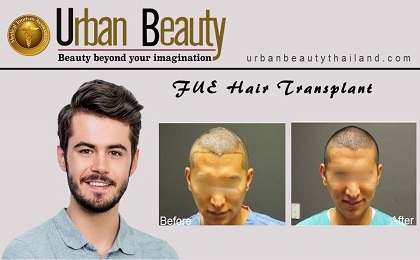 fue-hair-transplant-thailand