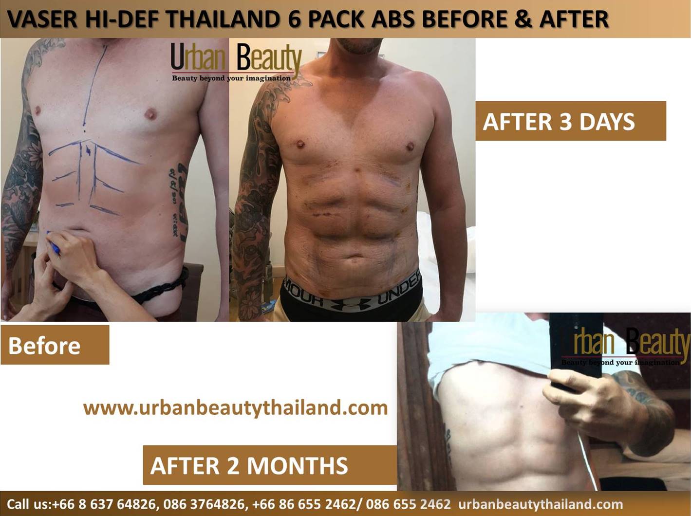 Lowest Cost From Flab to ABS VIA VASER HI-DEF in THAILAND - Urban