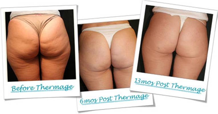 thermage body tightening thailand