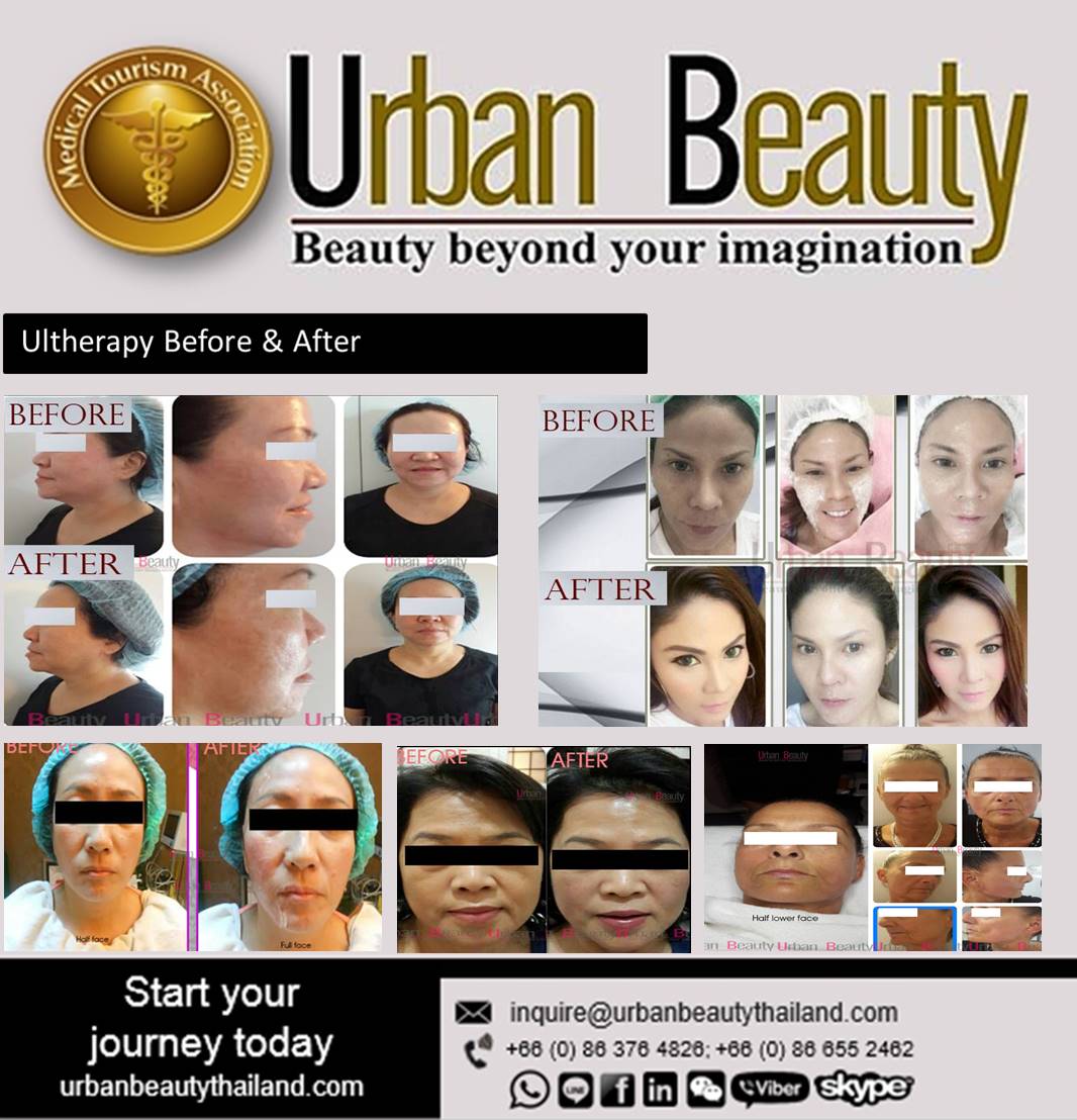 ulthera facelift before after thailand