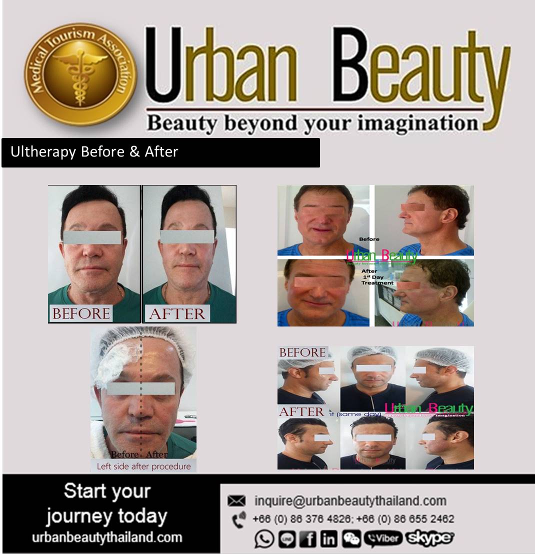 ultherapy before and after thailand