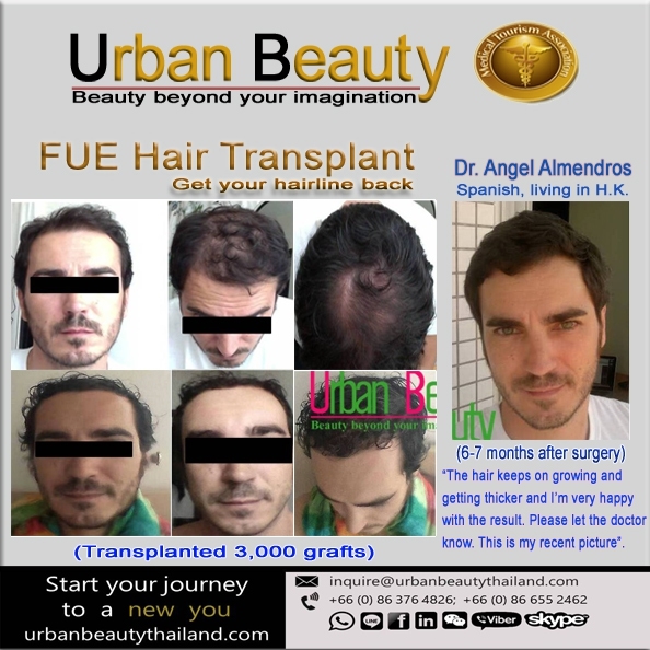 fue-hair-transplant-thailand