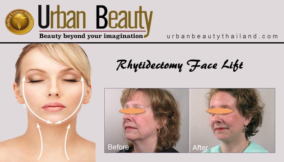 Rhytidectomy facelift thailand