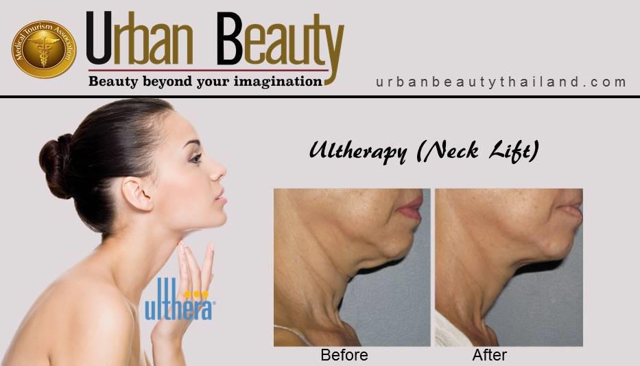 Ultherapy_necklift double chin bankok