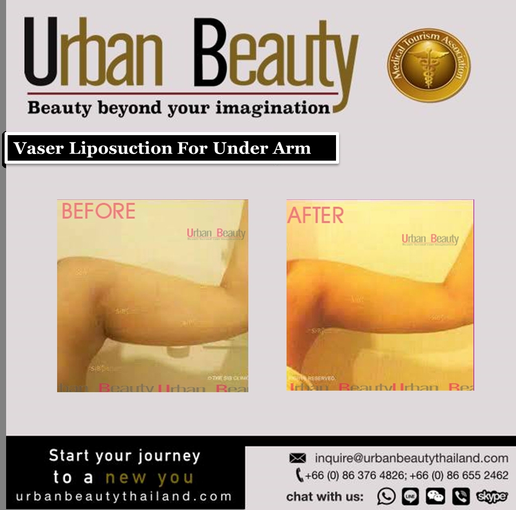 arm liposuction thailand