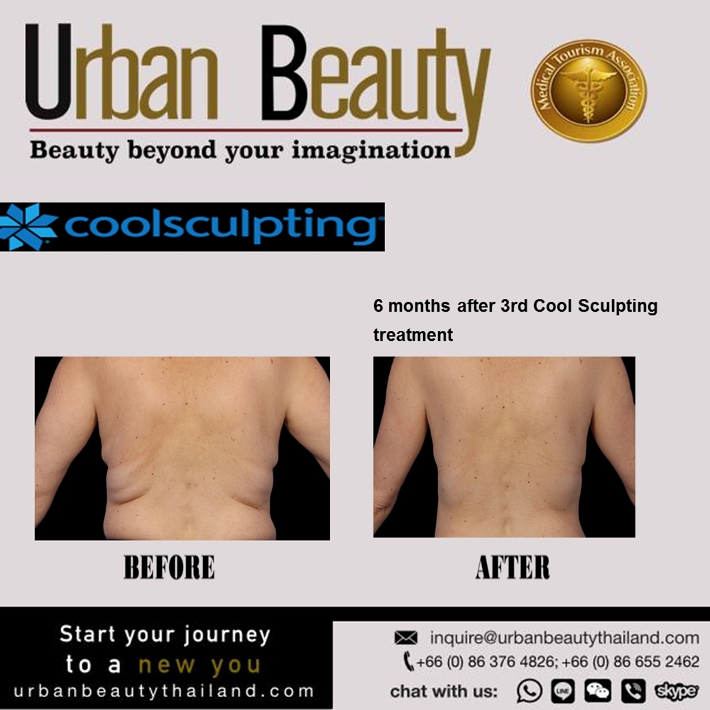 coolsculpting phuket bangkok