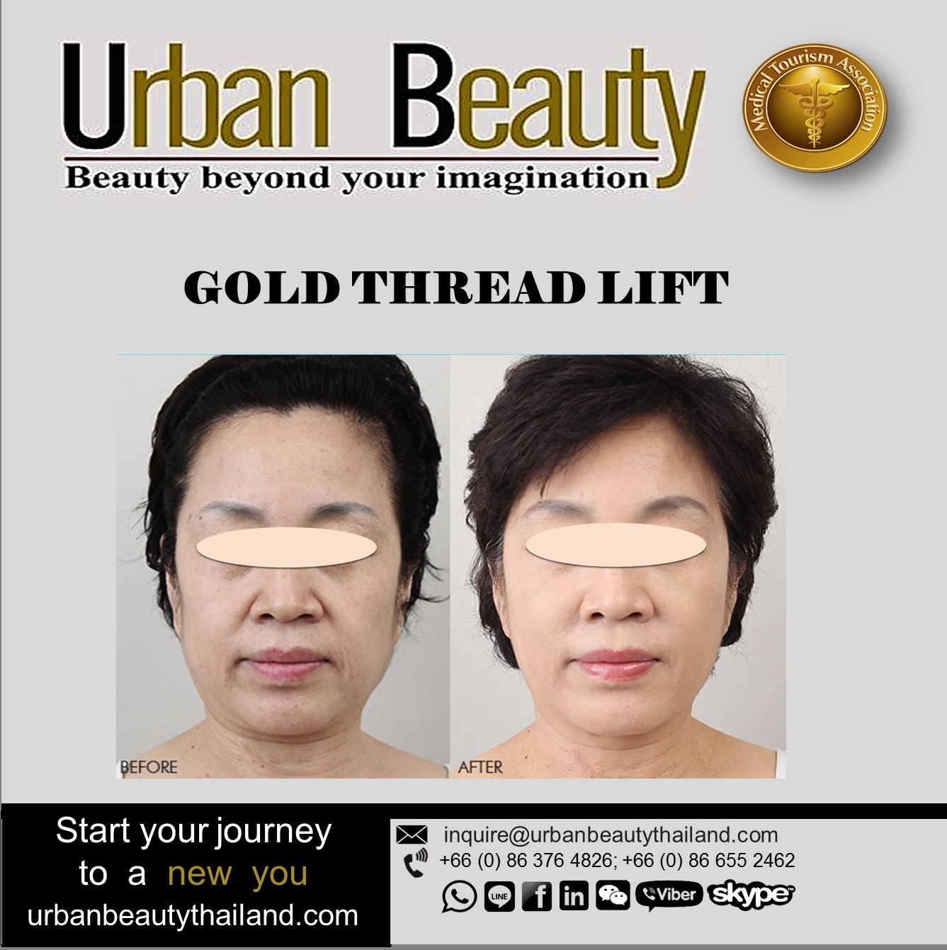 Gold Thread Lift- Face Lift Thailand