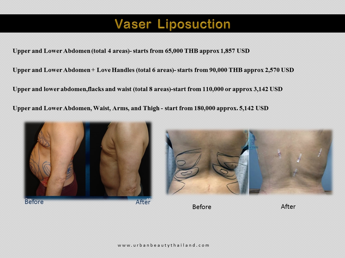 liposuction thailand