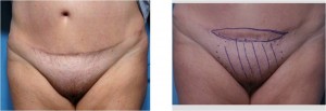pubic lift liposuction bangkok thailand