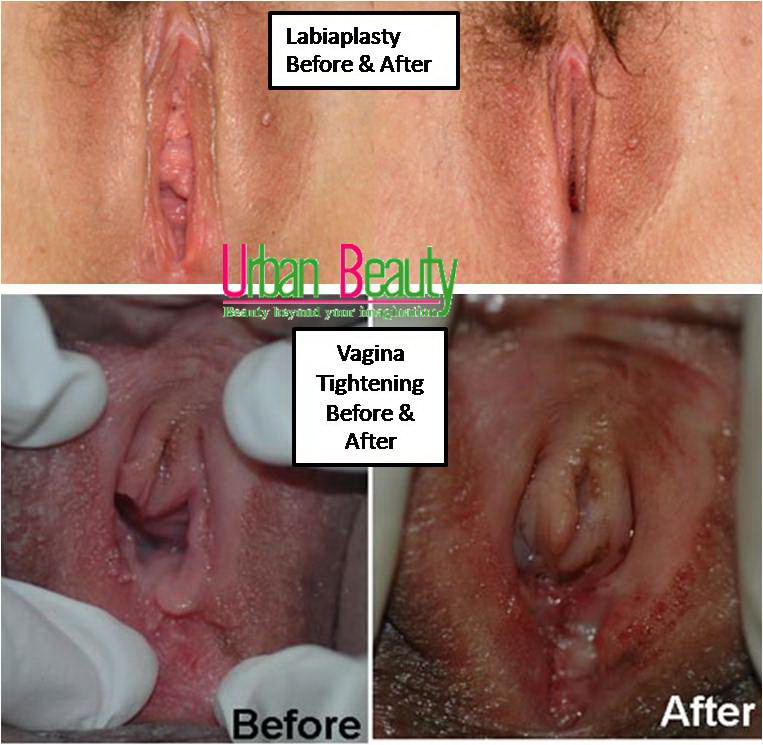 vagina tigtening and labiaplasty thailand