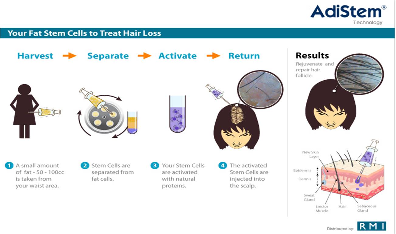 stemcell fat hair loss female