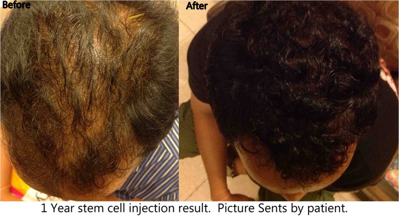 stemcell hair loss treament Bangkok Thailand before after