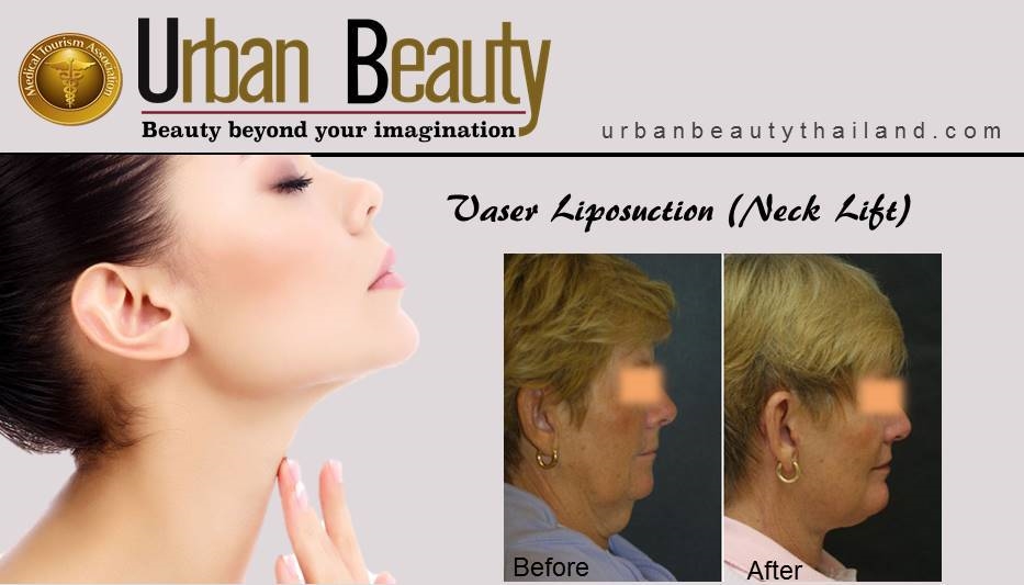 Vaser Lipo Neck Lift thailand