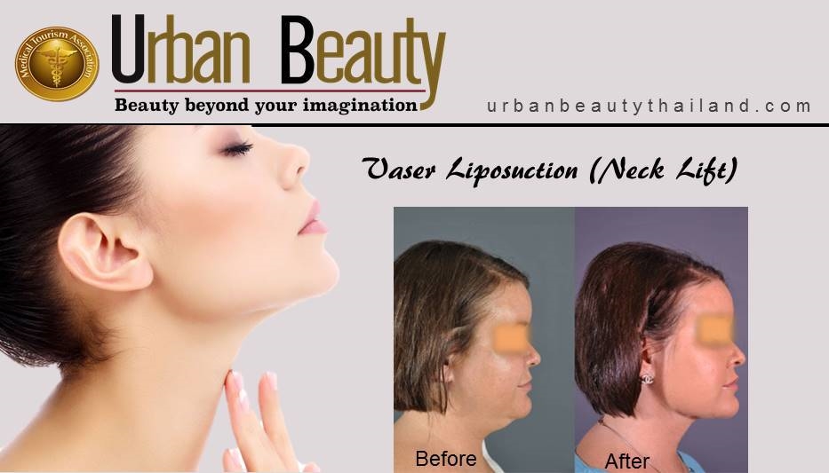 Vaser Lipo Neck Lift_bangkok thailand