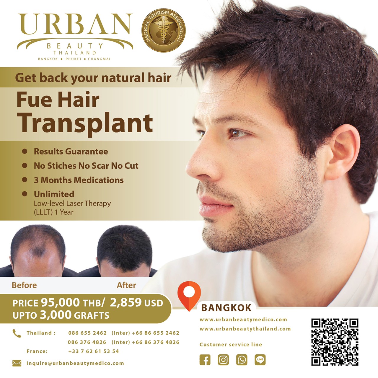 Hair Transplant Technique in Thailand - Urban Beauty Thailand